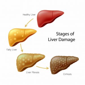 The Finer Points of a Diet for Cirrhosis of the Liver - Gerry White Pinco